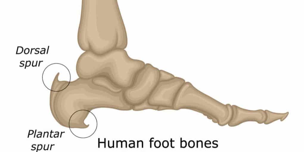 Heel Spur