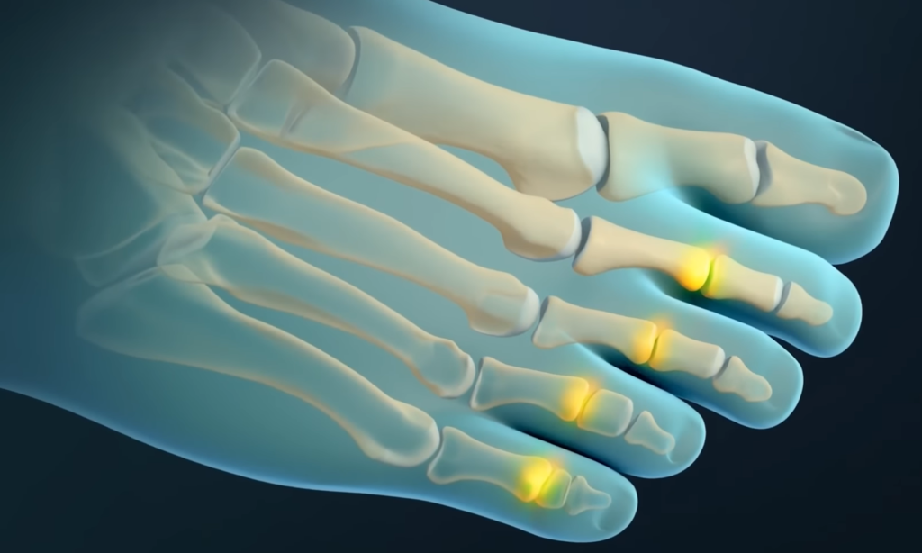 An X-ray illustration showing bones in a foot with highlighted areas