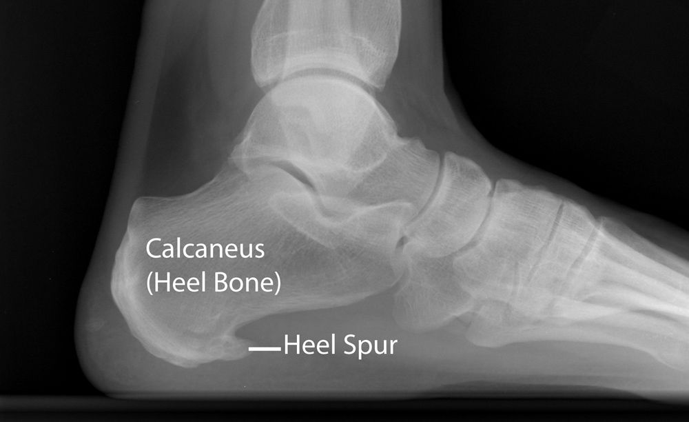 heel spurs on X-rays