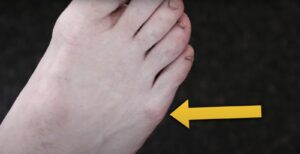 Foot with inflamed problem