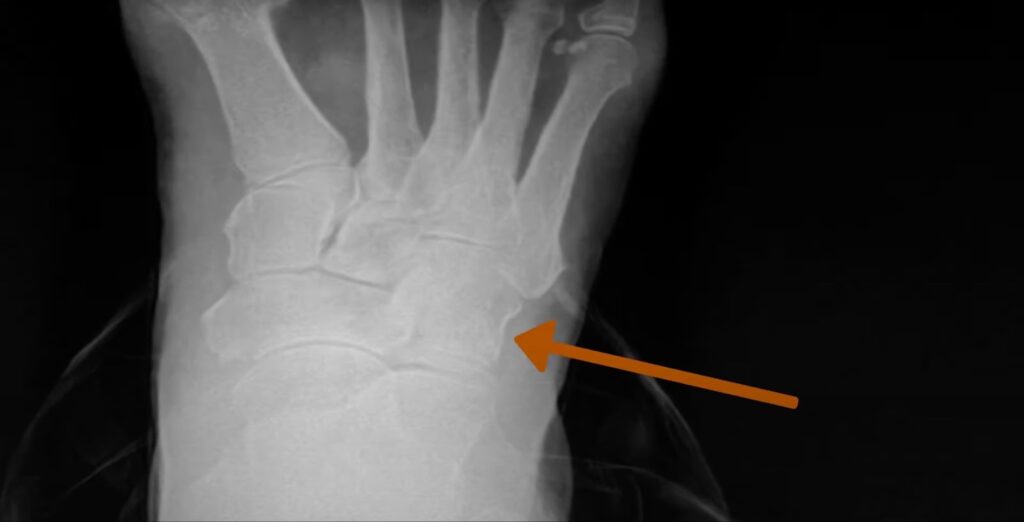 X-ray of the foot