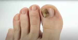 Fungal Nail