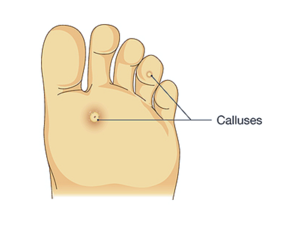 Corns and Calluses