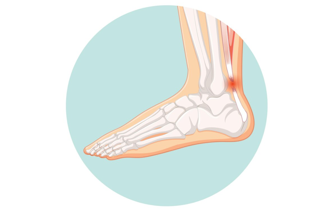 Illustration of a human ankle with pain highlighted in red