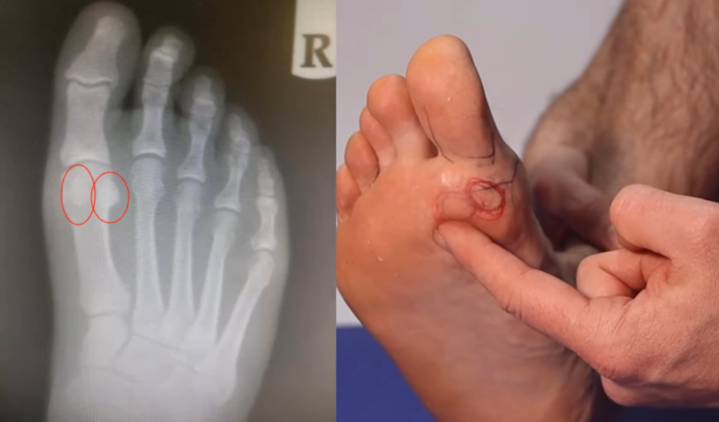 An X-ray and close-up of a foot showing signs of injury