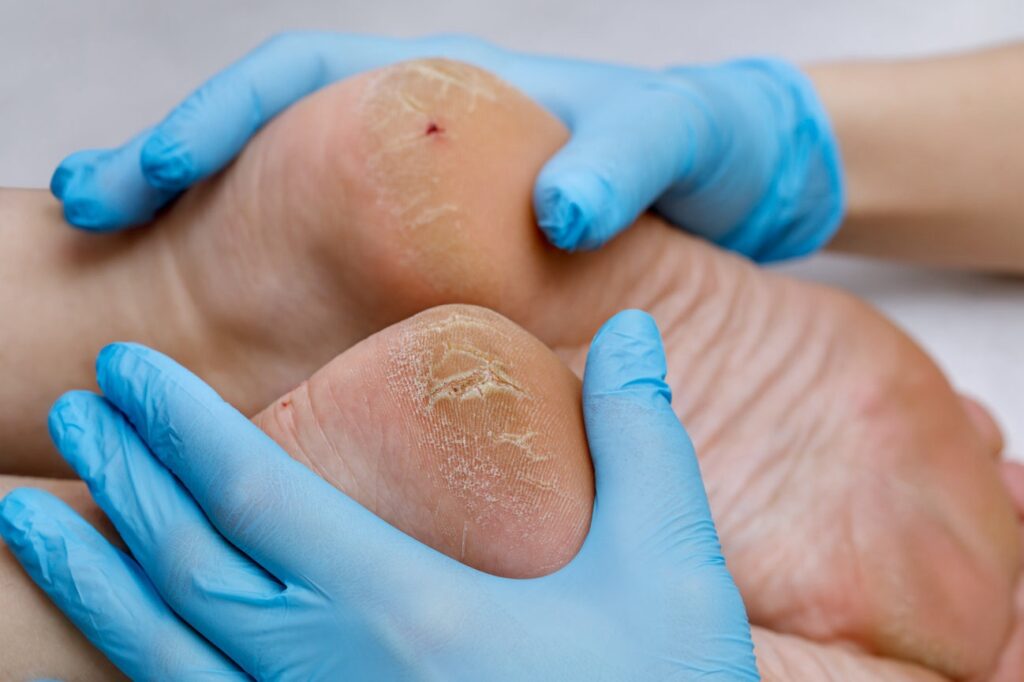 Doctor examines cracked heels