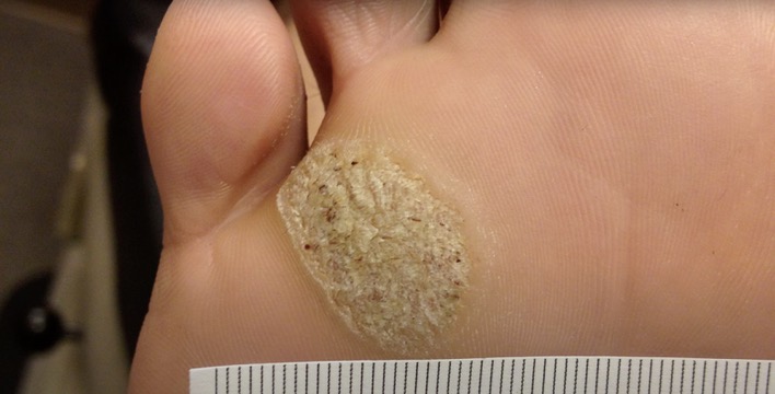 Plantar wart