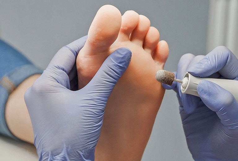 The doctor cleans the plantar wart