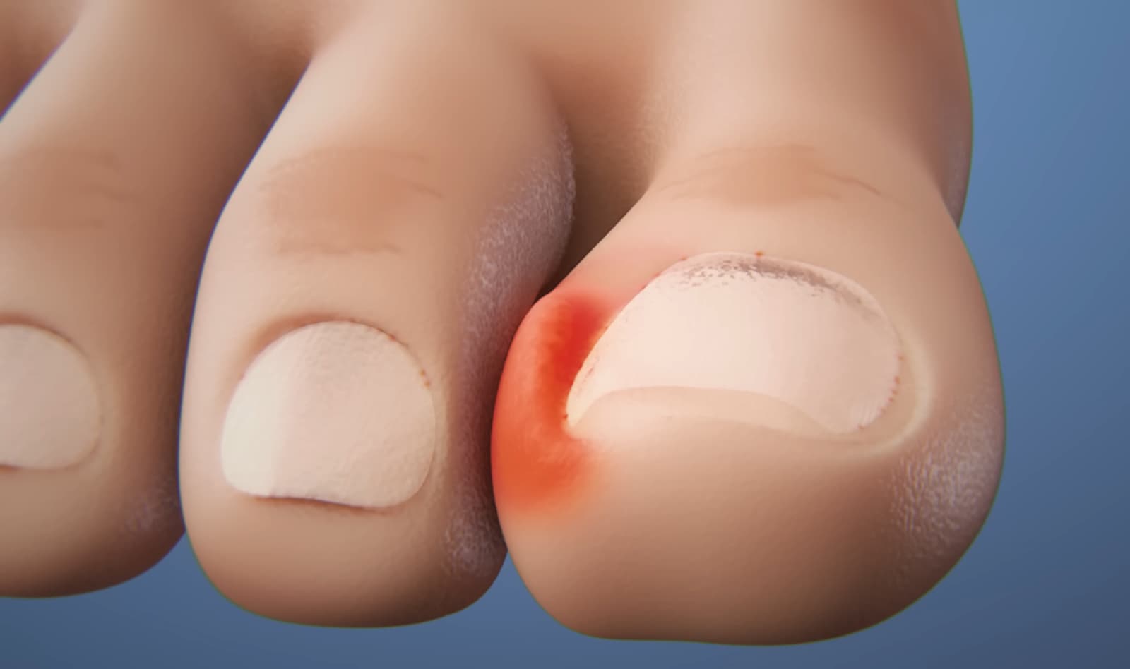 A rendered image of a toe post-nail avulsion with visible redness