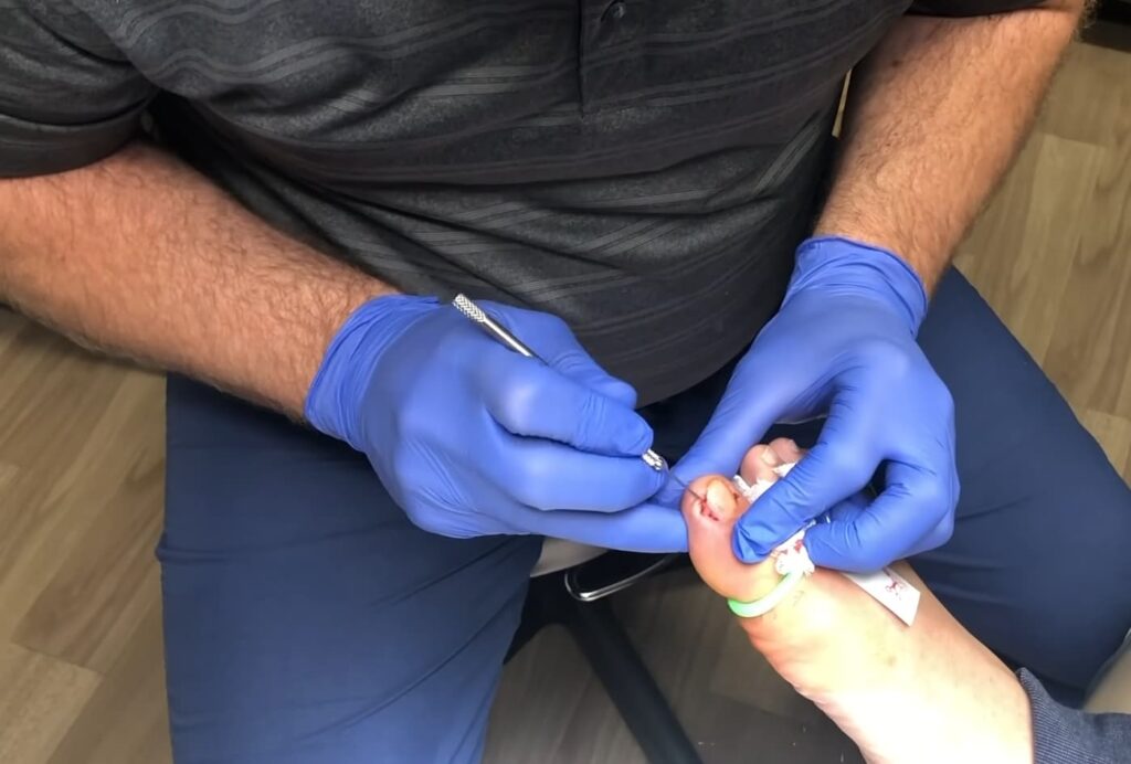 A practitioner performs a procedure on an ingrown toenail