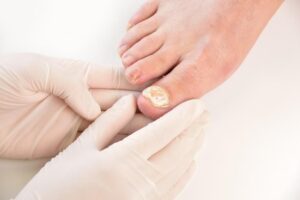 Doctor checking toenail fungus