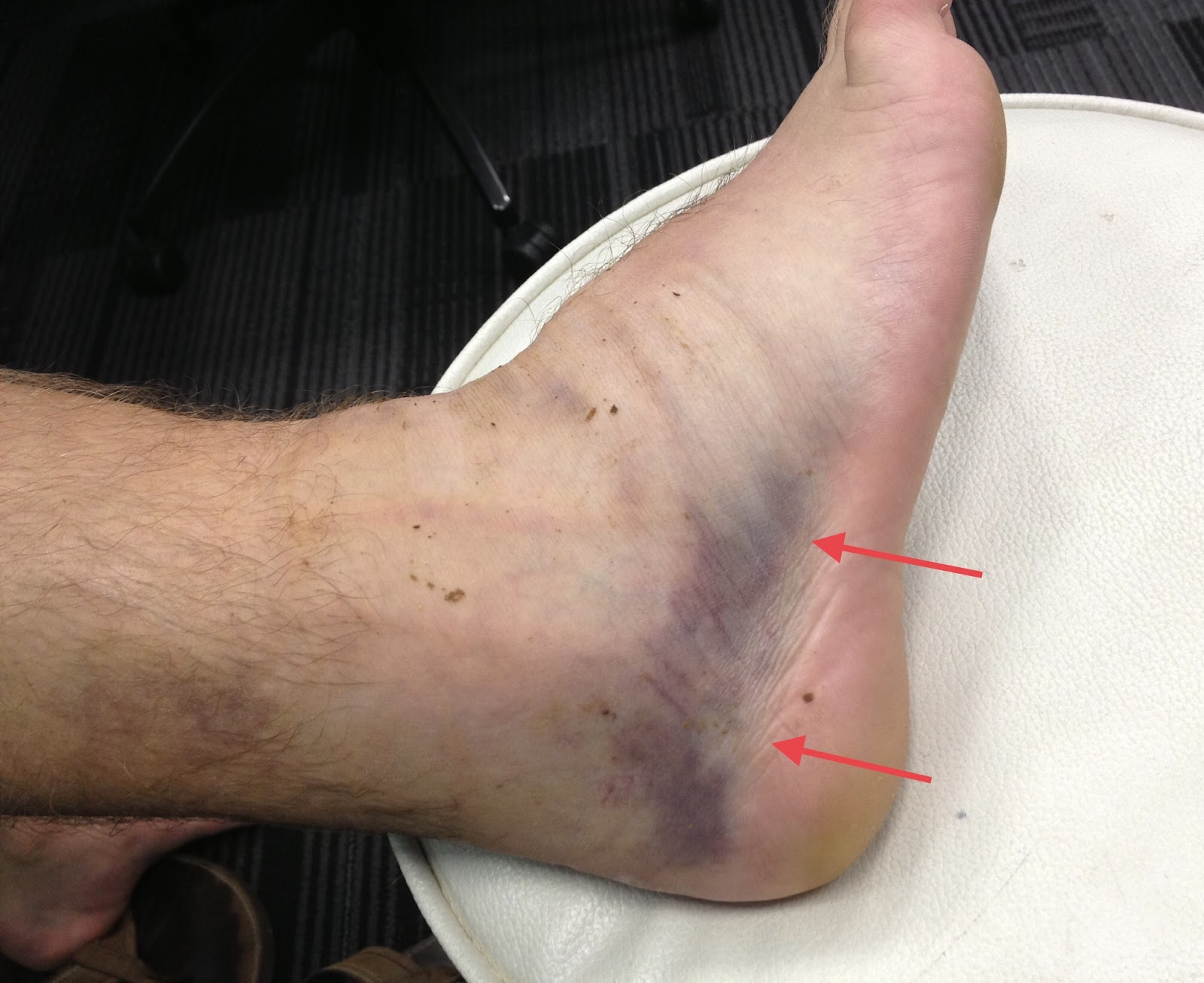 Chronic Ankle Instability: A Comprehensive Guide